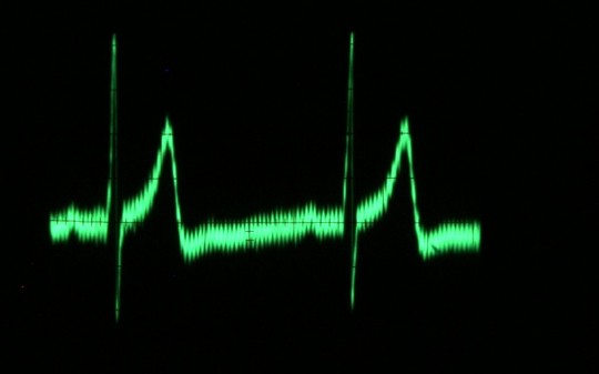 Electro Cardiogram (ECG)